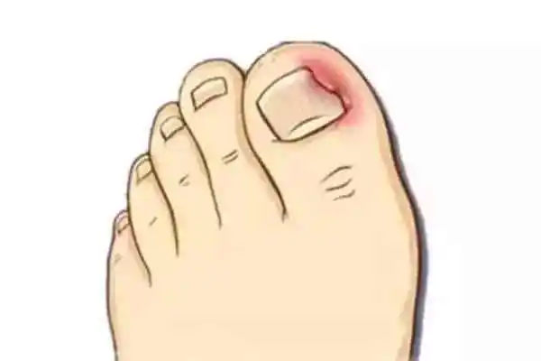 Ingrown Toenails: Causes, Stages, Home Treatment, Clinical Options, and Prevention — 2026 Complete Guide