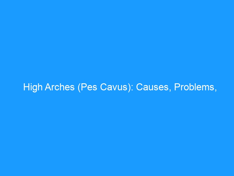High Arches (Pes Cavus): Causes, Problems, Treatment, and the Best Shoes — 2026 Complete Guide