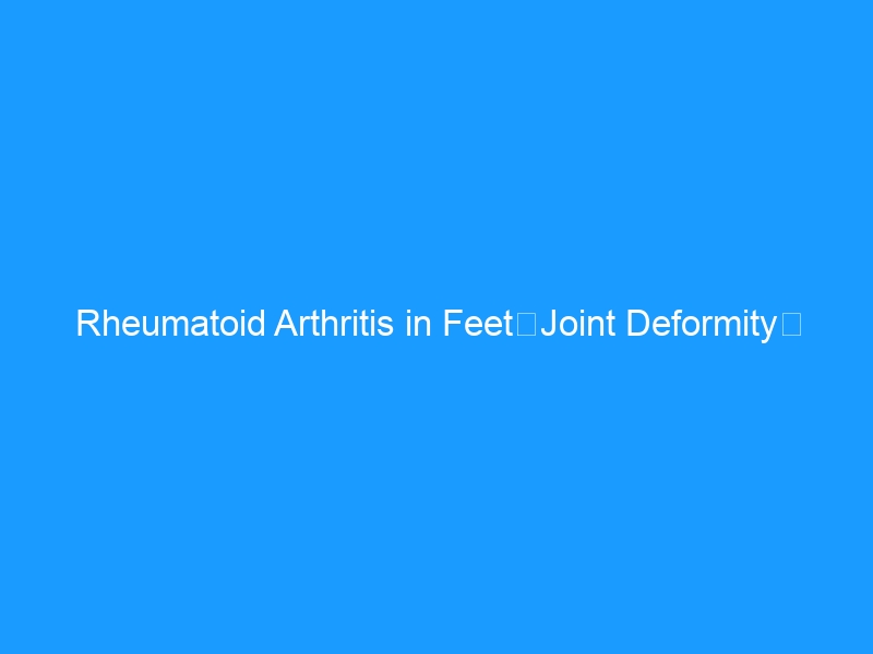 Rheumatoid Arthritis in Feet（Joint Deformity） – Complete Guide 2026