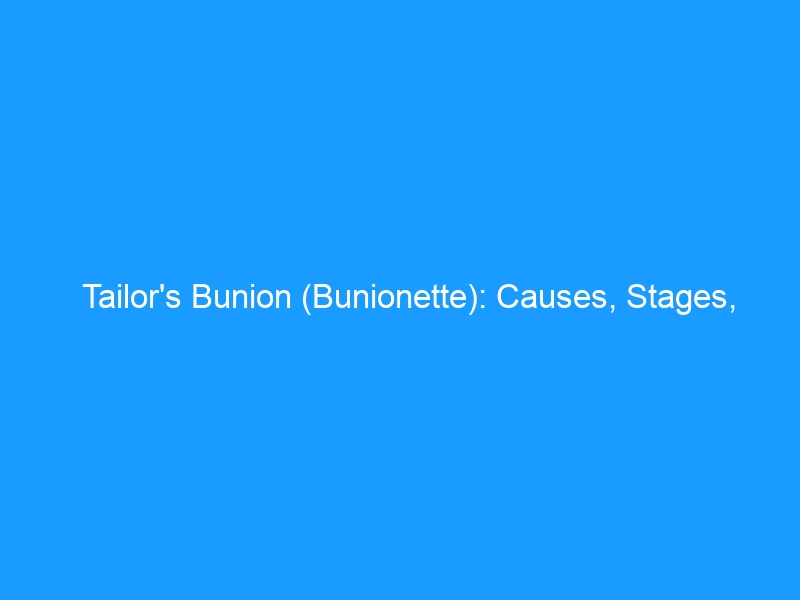 Tailor’s Bunion (Bunionette): Causes, Stages, Conservative Treatment, Surgery, and the Best Shoes — 2026 Complete Guide