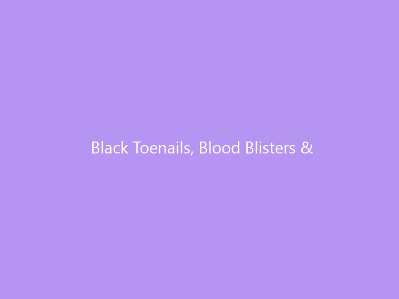 Black Toenails, Blood Blisters & Beyond: The Complete Guide to Marathon Runners and Toenail Damage